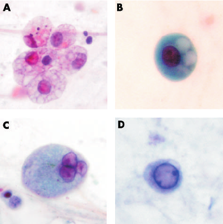 Morphological-changes-of-macrophages-including-A-cytoplasmic-foaminess-B-distinct